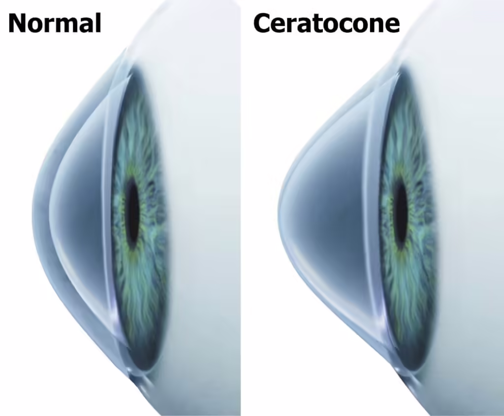 Comparação de olho normal e olho com ceratocone
