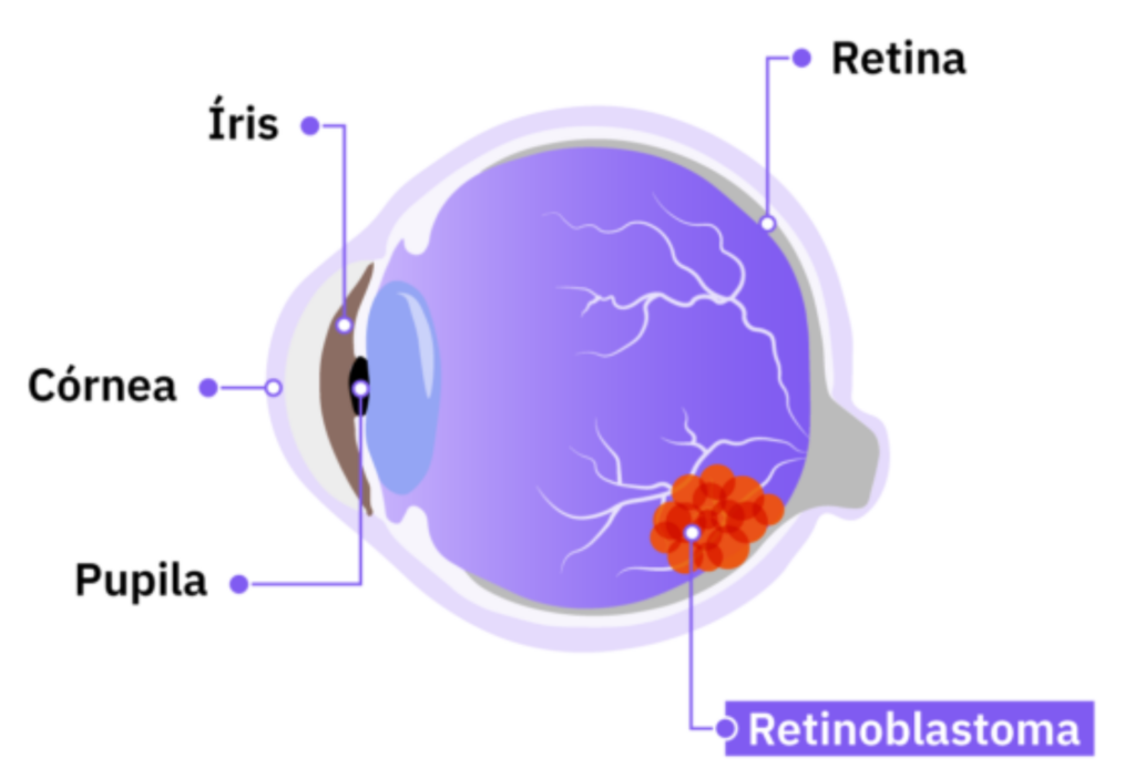 olho com retinoblastoma